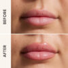Lip Filler